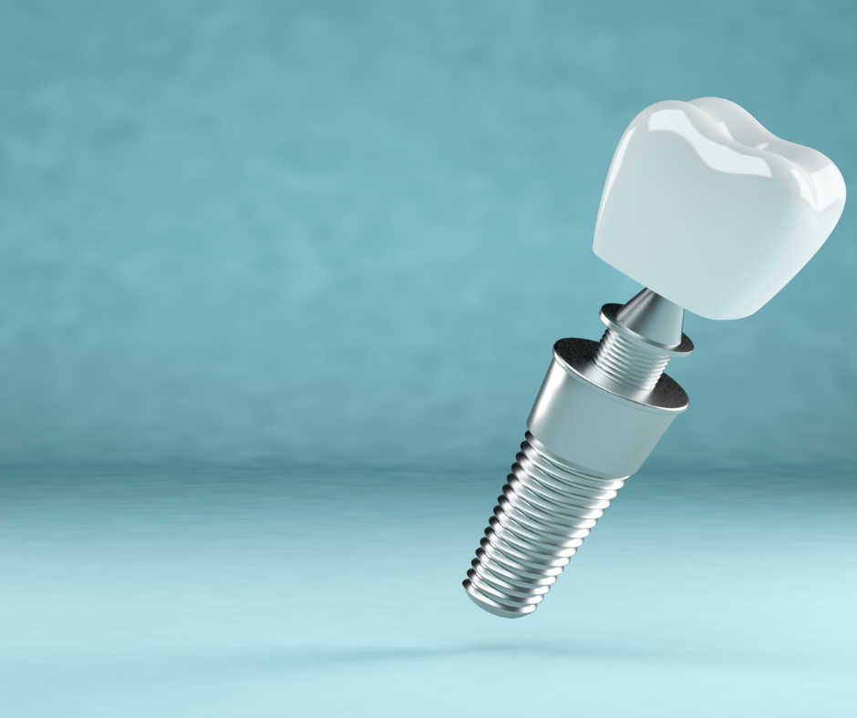 implantes dentales en Loranca